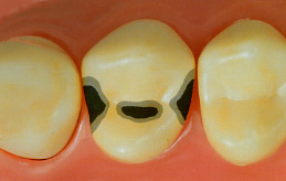 臼歯インレー